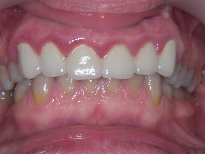 allergiamentes-cirkon-hid