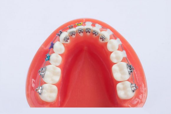 belso_fogszabalyzo-580x387