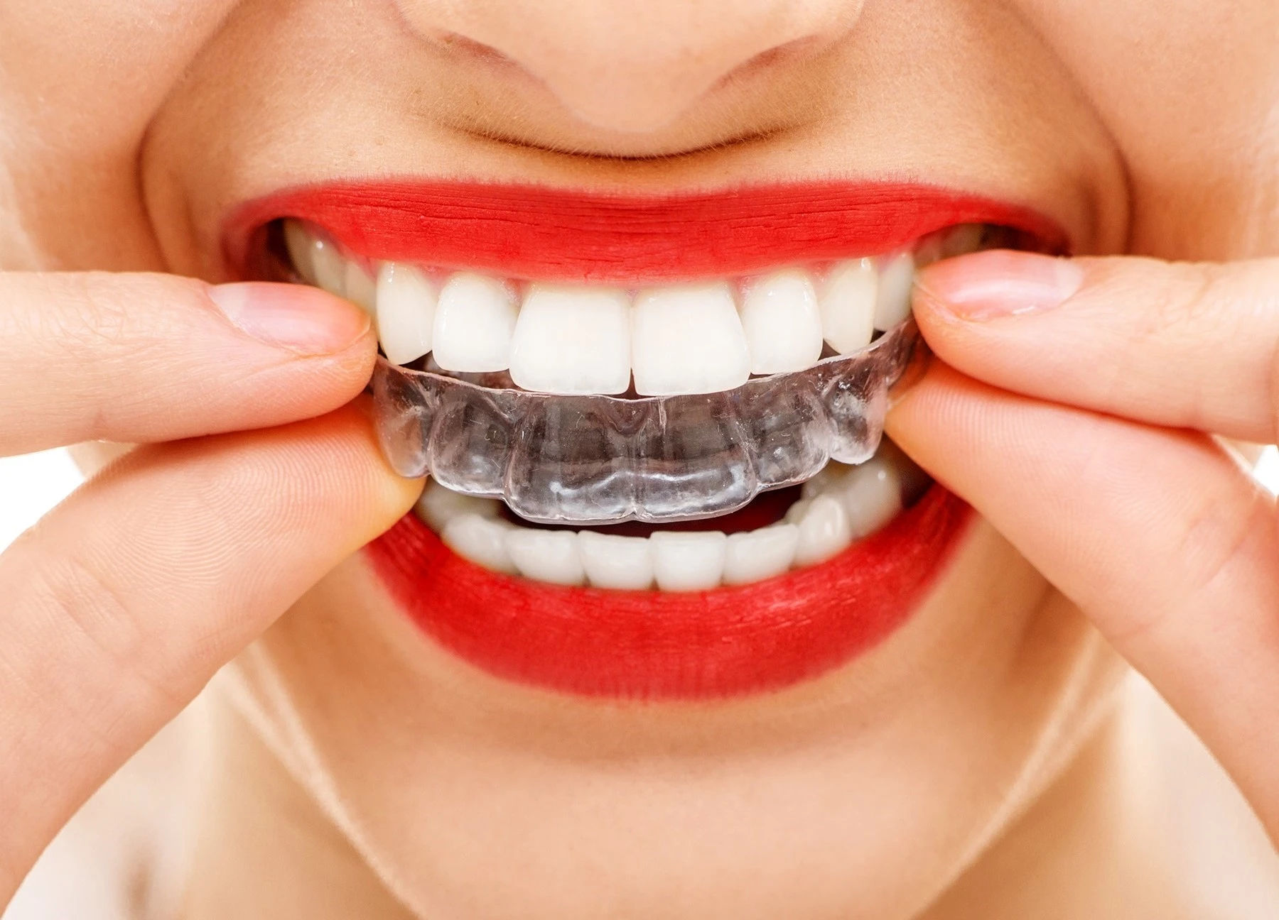 ejszakai-fogszabalyzo-felnott-korban