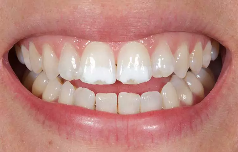 feher-foltok-a-fogon