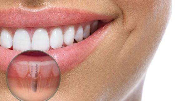 fog-implantacio-menete