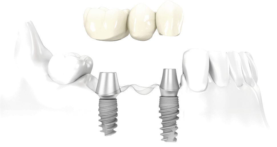 fog-implantatum-arak