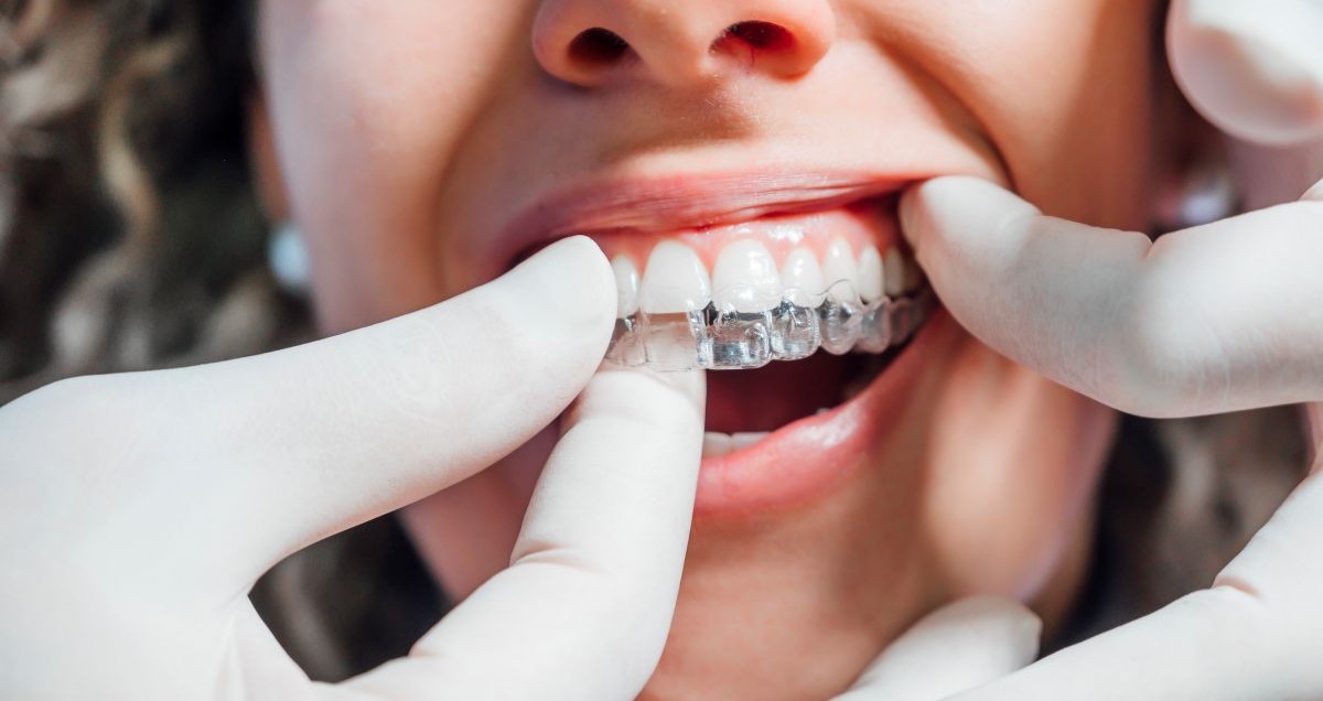 láthatatlan-fogszabályozó-blog