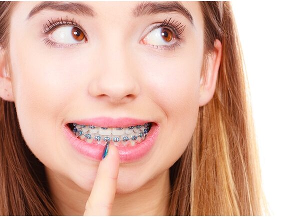 rogzitett-fogszabalyozo-keszulek-580x435